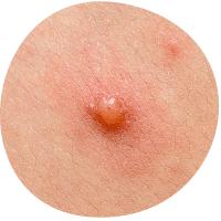 Chickenpox blister