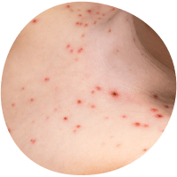 Chickenpox rash