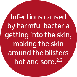 Infections caused by harmful bacteria getting into the skin, making the skin around the blisters hot and sore.