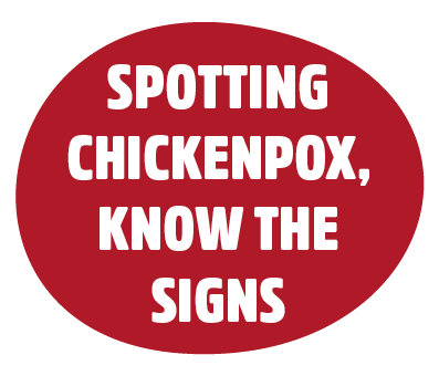 Spotting chickenpox, know the signs. Learn what to look for by clicking here.