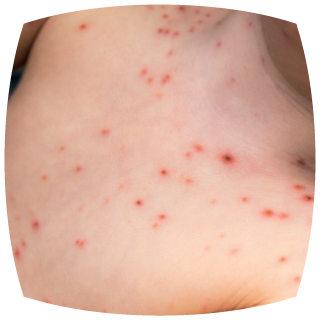 The Rash